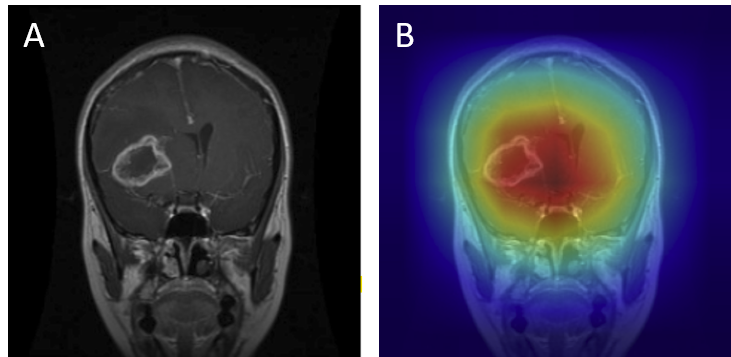 Glioma Correct