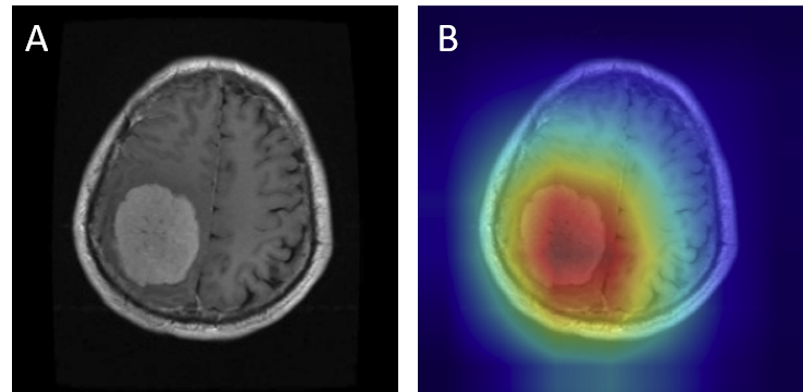 Meningioma Correct