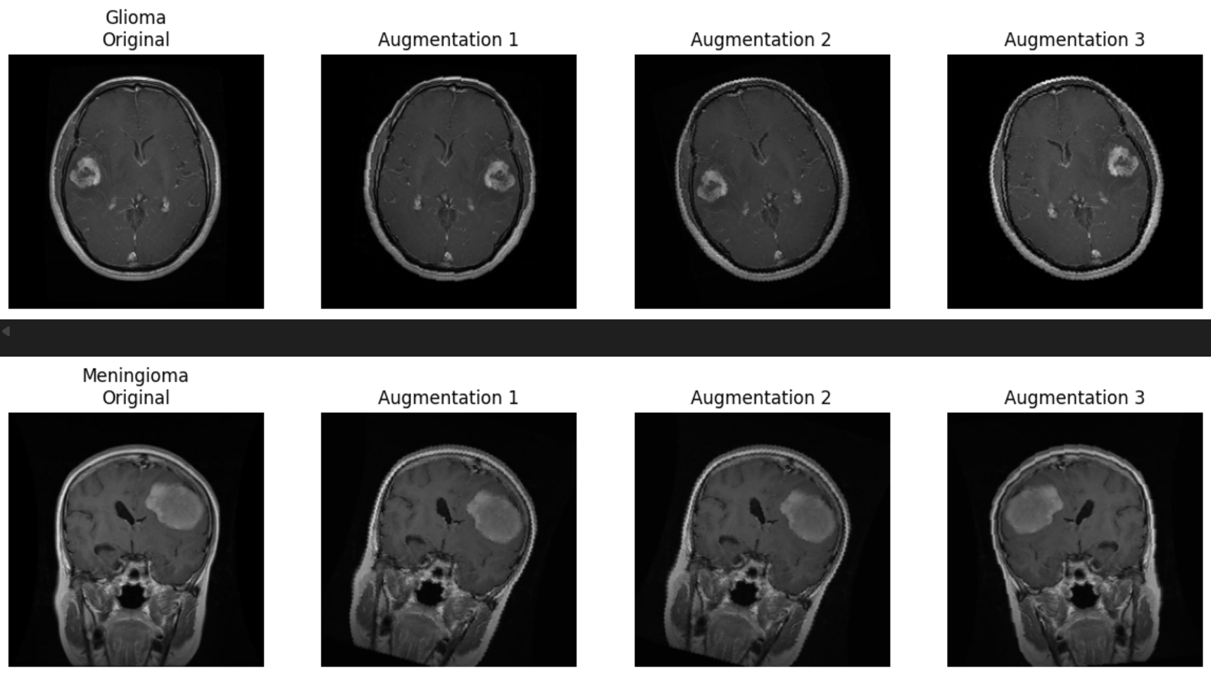 MRI Augmentation Samples